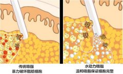 大腿吸脂，控制饮食还是很重要的 width=