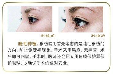 FUE种植睫毛你敢不敢，不敢就看我的