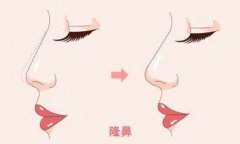 对于亚洲鼻整形术，他有什么技术来抬高我的桥梁? width=