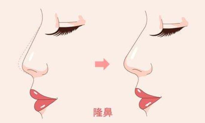 【对于亚洲鼻整形术，他有什么技术来抬高我的桥梁?】