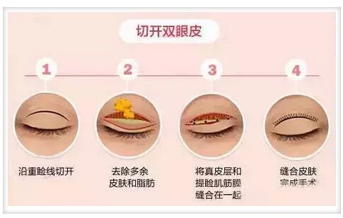 割双眼皮好还是埋线好?来北京新星靓告诉你怎样选择~