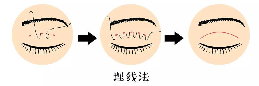 割双眼皮好还是埋线好?来北京新星靓告诉你怎样选择~