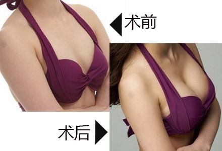 做康宁玛格丽特假体隆胸具有哪些特点?备受每个女士信任。