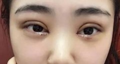 怎样判断是双眼皮肉条还是肿？看看区别对比图片吧！ width=