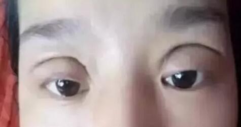 【怎样判断是双眼皮肉条还是肿？看看区别对比图片吧！】