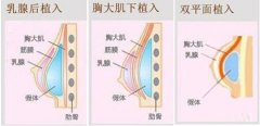 做双平面假体丰胸一次就可以成功吗?深受大多数女人欣赏 width=