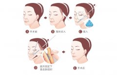 面部悬吊除皱术原理解析 width=