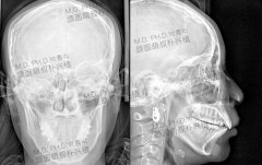 颧骨高怎么办？我去首尔丽格偷了一份专家的报告！ width=