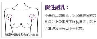 副乳切除切口开在什么地方?明X吗?