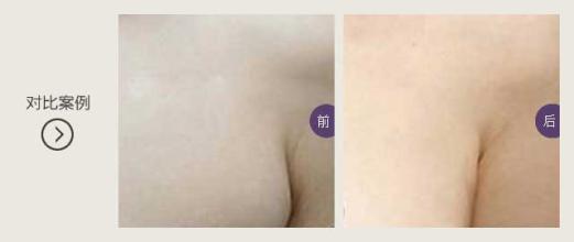副乳切除切口开在什么地方?明X吗?