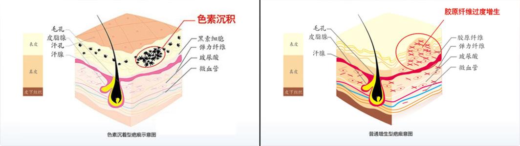 马鞍山去疤痕多少钱?