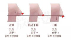 胸部下垂的状况有哪些? width=