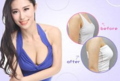 做假体隆胸的果和材料有关吗? width=