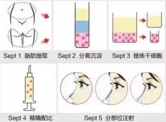 自体脂肪隆鼻的过程怎么样? width=
