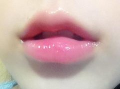 自体脂肪丰唇珠能维持多久? width=