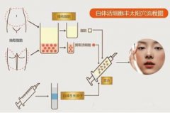 自体脂肪丰太阳穴可以保持多久? width=