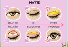 上睑下垂矫正术的果如何保障？来看看哇！ width=