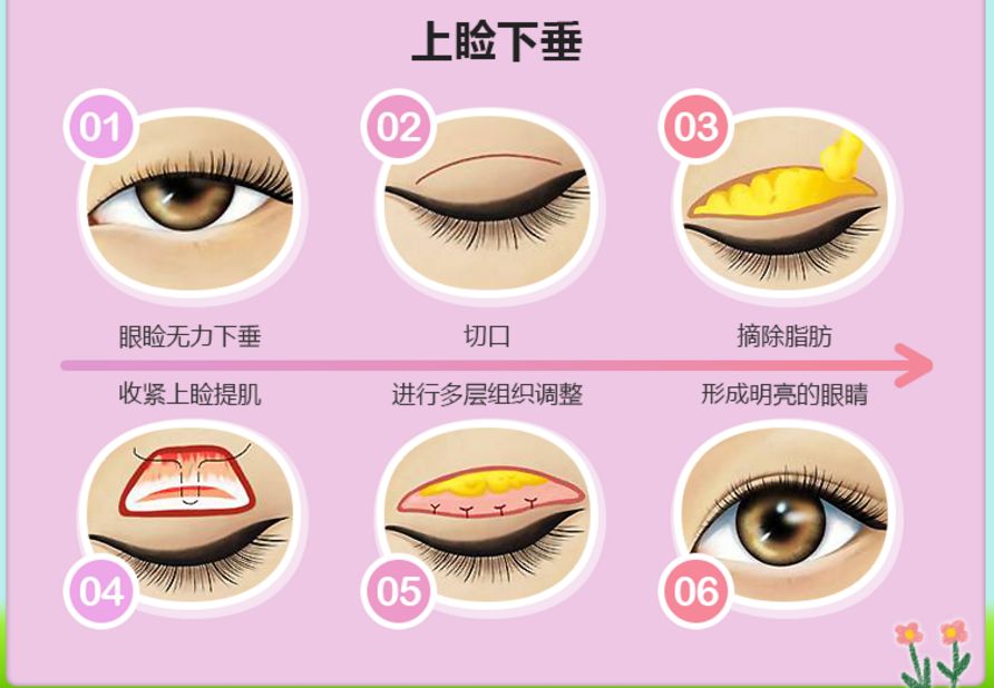 上睑下垂矫正术的果如何保障？来看看哇！