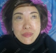 耳软骨隆鼻花费了我2.4W,做完后塌鼻梁和大鼻头都改良了~ width=