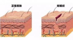 激光美容助你消除产后妊娠纹 width=