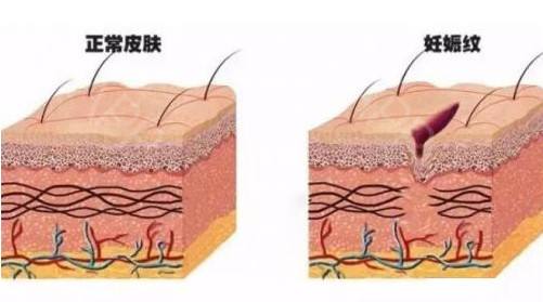激光美容助你消除产后妊娠纹