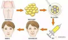 自体脂肪除皱真让我年轻十岁 width=