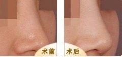 肋软骨隆鼻做好了来看果图 width=