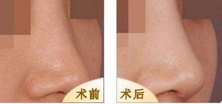 肋软骨隆鼻做好了来看果图