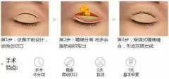切开双眼皮果持久不怕双眼皮会消失 width=