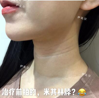 怎么去除颈纹果好？嗨-体美颈针是好东西，哈哈！