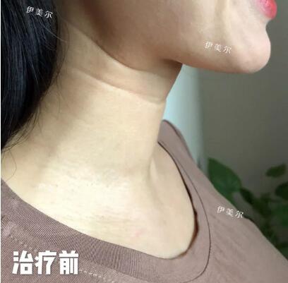 怎么去除颈纹果好？嗨-体美颈针是好东西，哈哈！