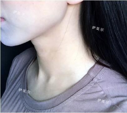 怎么去除颈纹果好？嗨-体美颈针是好东西，哈哈！