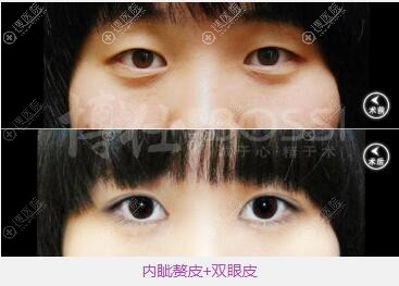 广州博仁张建军做的双眼皮术后眼睛更有神