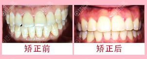 【上海尤旦口腔正规靠谱吗？牙齿矫正案例价格表及医院资质来揭晓！】