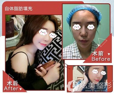 张民福院长自体脂肪填充术后125天恢复果