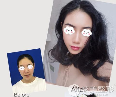 贾虹院长自体脂肪填充术前术后照片对比