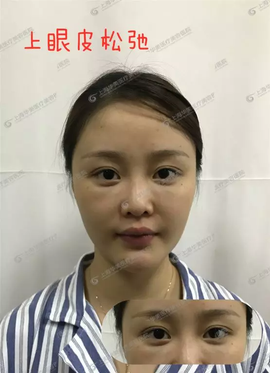 做双眼皮前不搞清楚这个问题，小心被坑惨~