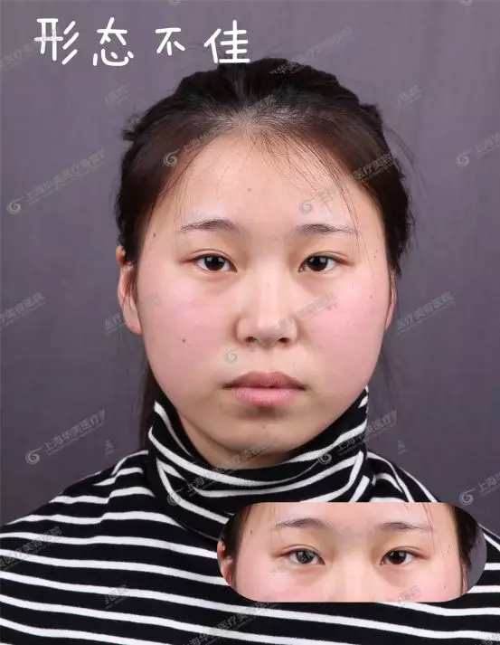 做双眼皮前不搞清楚这个问题，小心被坑惨~