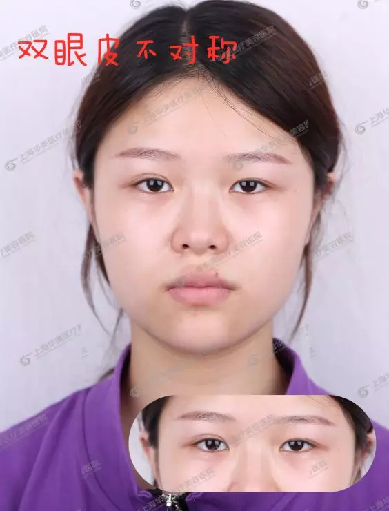 做双眼皮前不搞清楚这个问题，小心被坑惨~