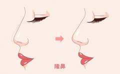 为什么选择约翰霍普金斯面部整形手术？我们期待什么？ width=