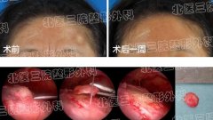 粉瘤是什么？有图片吗？下面就是科普来啦！ width=