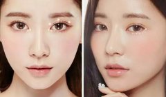 天使之翼真人案例术前术后对比。 width=