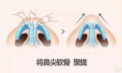 成都医美整形鼻小柱延长塑造鼻子。 width=