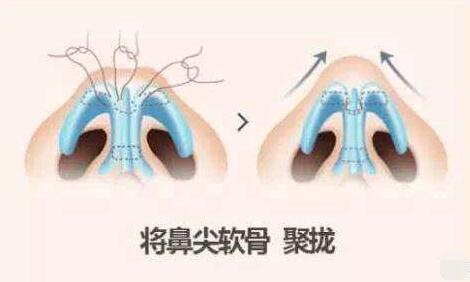 成都医美整形鼻小柱延长塑造鼻子