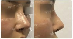 厦门修志夫隆鼻修复案例对比，该如何拯救你，被做坏的鼻子? width=