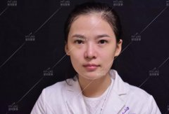 熊苏民面部埋线-提升+提眉真实案例反馈前后对比图 width=