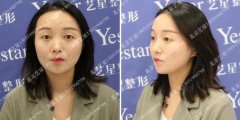 北京艺星全切双眼皮案例恢复对比真的很拉仇恨 width=