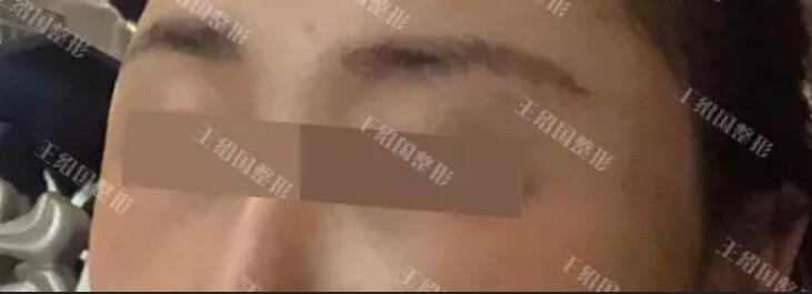 【共振技术只能用于吸脂吗？其实也可以取出！】