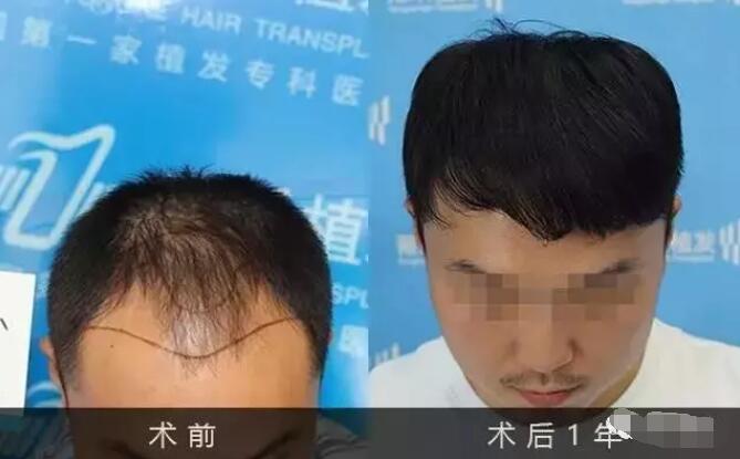 【博士园植发靠谱吗？博士园医院植发案例有吗？】