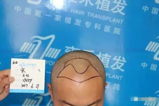 【博士园植发靠谱吗？博士园医院植发案例有吗？】